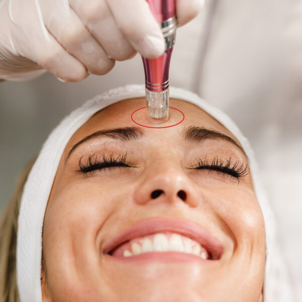 Micro-Needling | Face & Neck