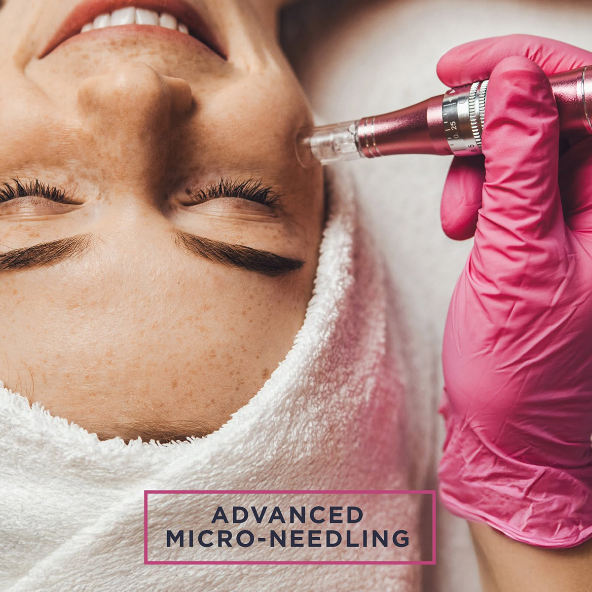 Micro-Needling | PROMO | Face & Neck - Image 5
